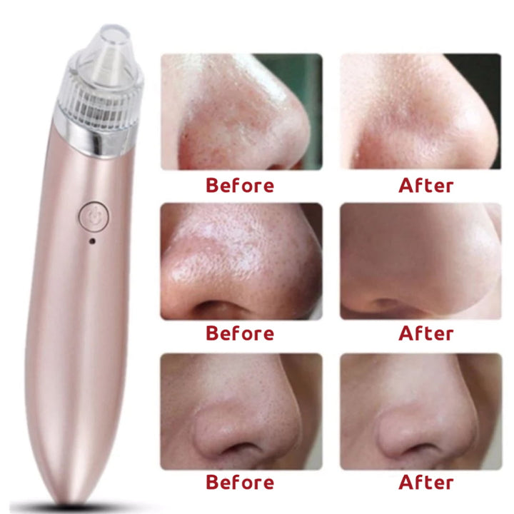 Blackhead Vacuum Acne Cleaner Pore Remover Electric Skin Facial Cleanser Care